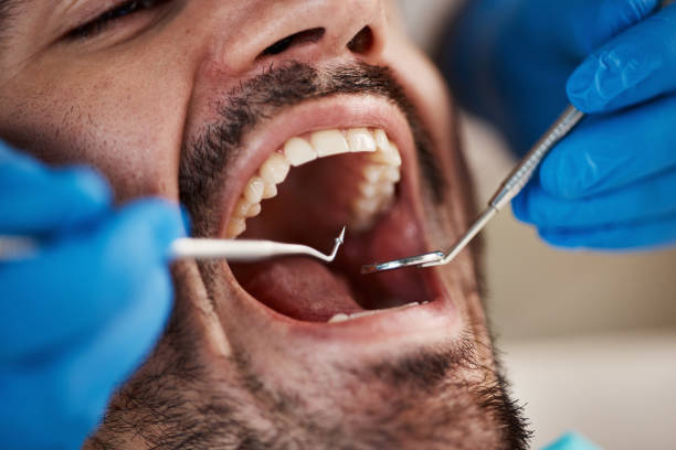 Best Emergency Dental Care for Broken or Chipped Teeth in Biloxi, MS
