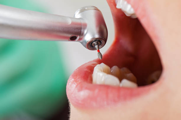 Best Emergency Treatment for Dental Infections or Abscesses in Biloxi, MS
